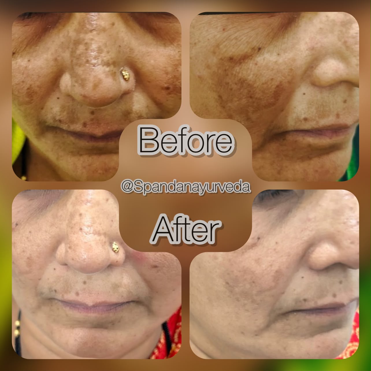 Facial pigmentation — clearer, even-toned skin
