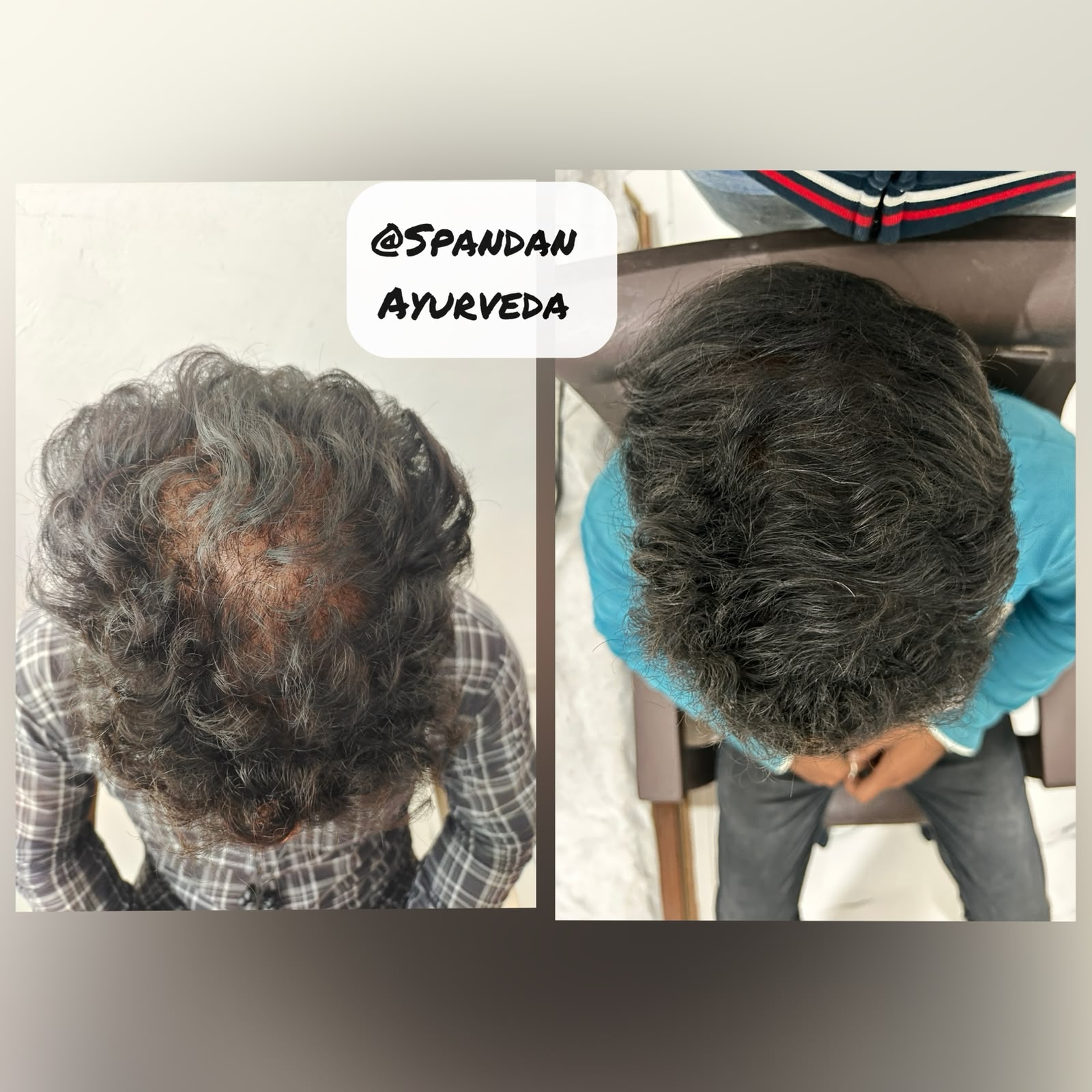 Hair regrowth — thinning crown to full coverage